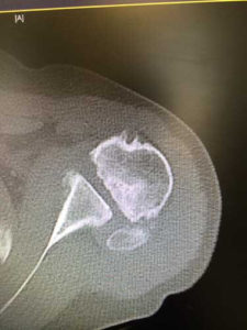 CT scan AVN shoulder horizontal slice