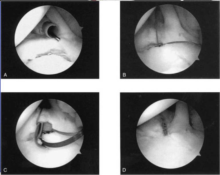 arthroscopic images of a slap repair