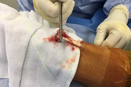 Left elbow ruptured distal biceps tendon delivered from the wound