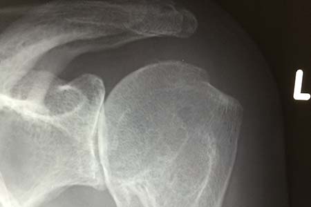 shoulder arthritis beard osteohpyte bone on bone