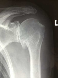 shoulder arthritis with beard osteohpyte bone on bone AP view