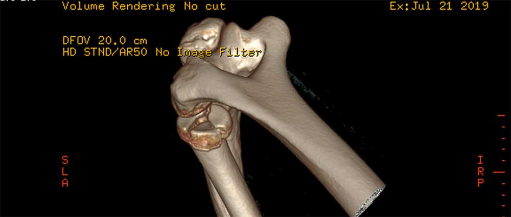 3d ct radial head fracture