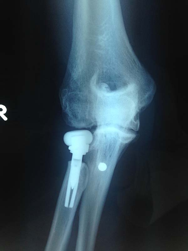 AP xray of radial head replacement for terrible triad injury now developing post traumatic arthritis