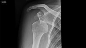 Anterior dislocation of the shoulder