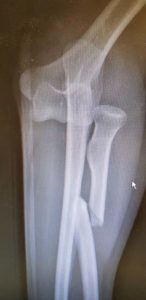 Elbow dislocation with radial shaft fracture AP