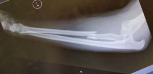 X-Ray of an Elbow dislocation with radial shaft fracture