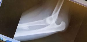 Elbow dislocation with radial shaft fracture lateral close up
