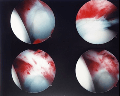 arthroscopic view of adhesive capsultis