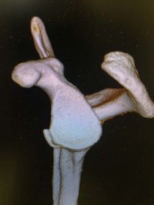 boney bankart lesion 3d CT scan from lateral