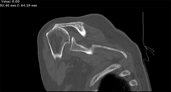 ct reconstruction of cuff tear arthropathy