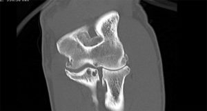 elbow OA on CT