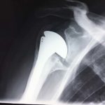 X-ray of a failed hemiarthroplasty causing pain with bone rubbing against bone