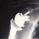 X-ray of a reverse total shoulder replacement