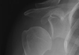 inferior subluxation of the humeral hea with some arthritis