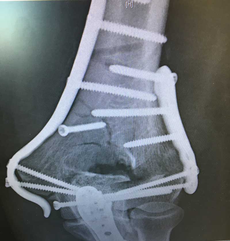 plating comminuted distal humeral fracture