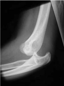 posterior dislocation seen on lateral xray