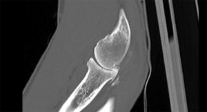 Radiocapitellar Osteoarthritis on CT scan