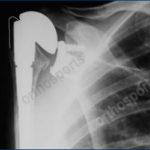 Dislocated Primary Shoulder Replacement with rotator cuff tear which requires revision to a reverse shoulder replacement