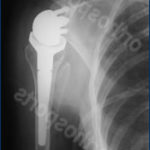 reverse shoulder replacement with stem in humerus