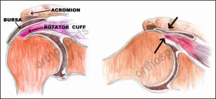 inflamed shoulder tendons