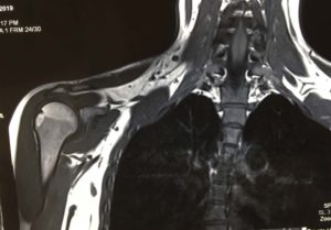 shoulder lungs and neck on mri