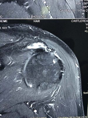 torn rotator cuff with loose anchor in subacromial space